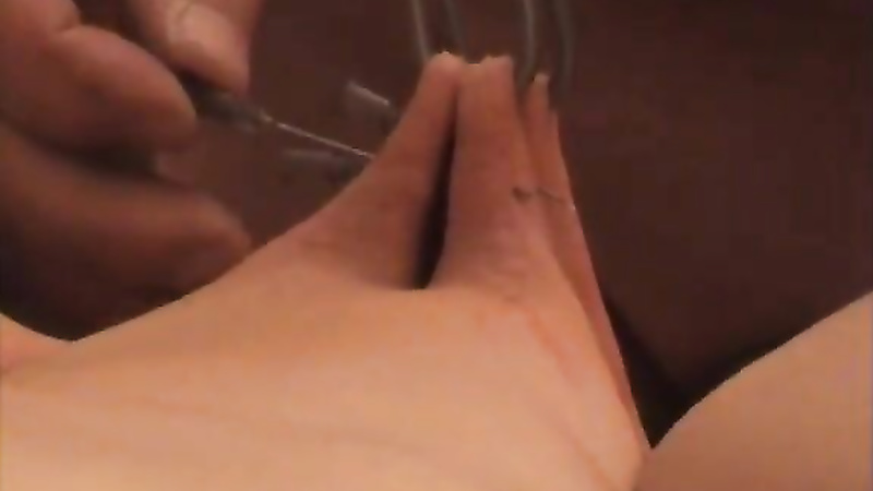 Bound hooked needles during anal