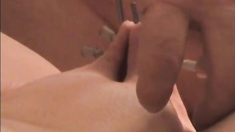 Bound hooked needles during anal