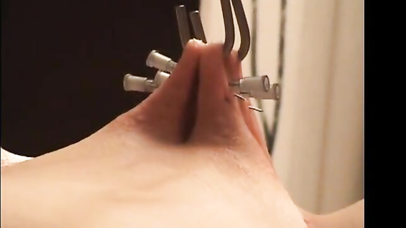 Bound hooked needles during anal