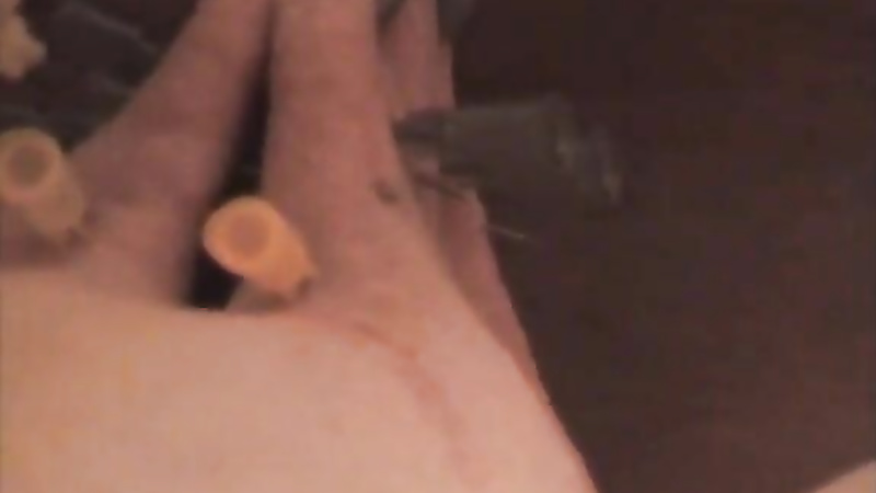 Bound hooked needles during anal