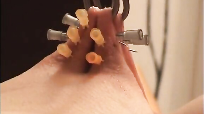 Bound hooked needles during anal