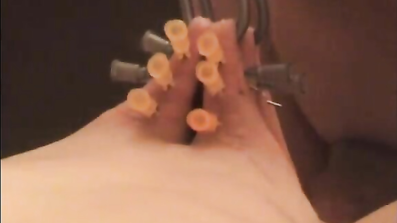 Bound hooked needles during anal