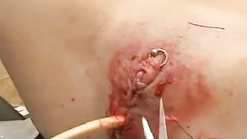 Sewn in cathader with clitoris needles