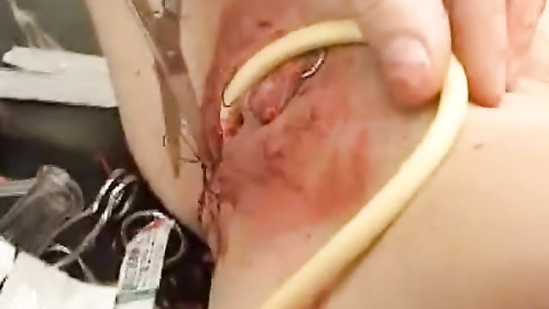 Sewn in cathader with clitoris needles