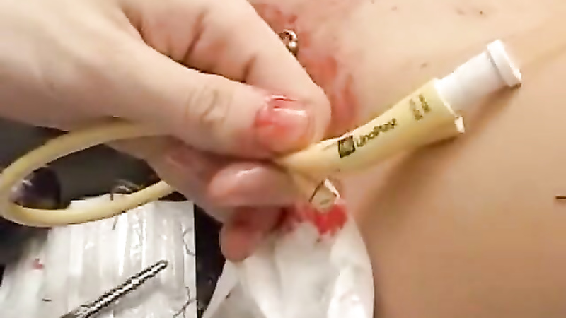 Sewn in cathader with clitoris needles