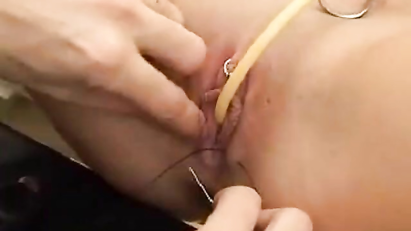 Sewn in cathader with clitoris needles