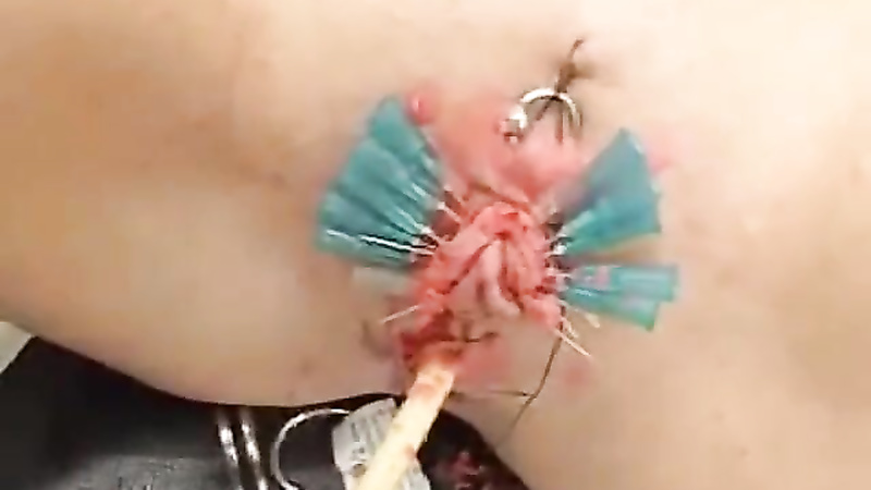 Sewn in cathader with clitoris needles