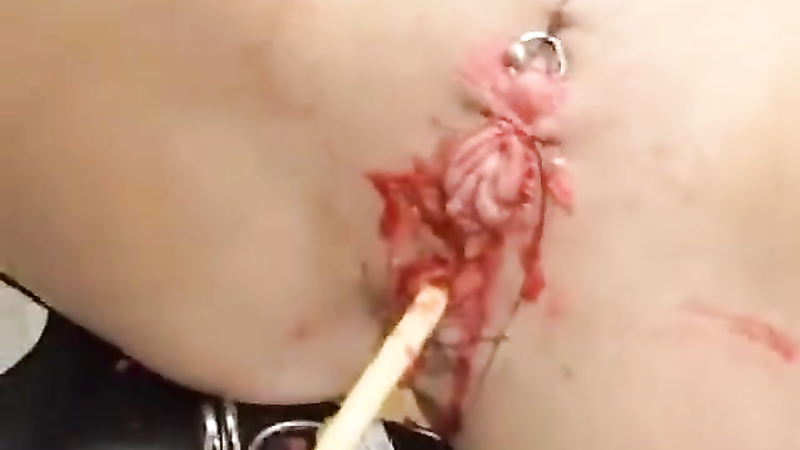 Sewn in cathader with clitoris needles