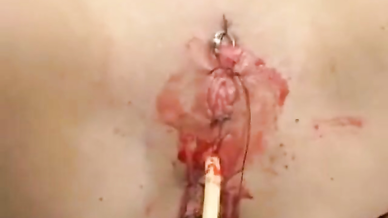 Sewn in cathader with clitoris needles