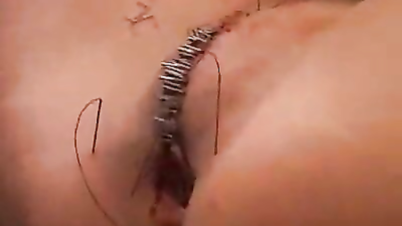 TG pussy sewing and stapling